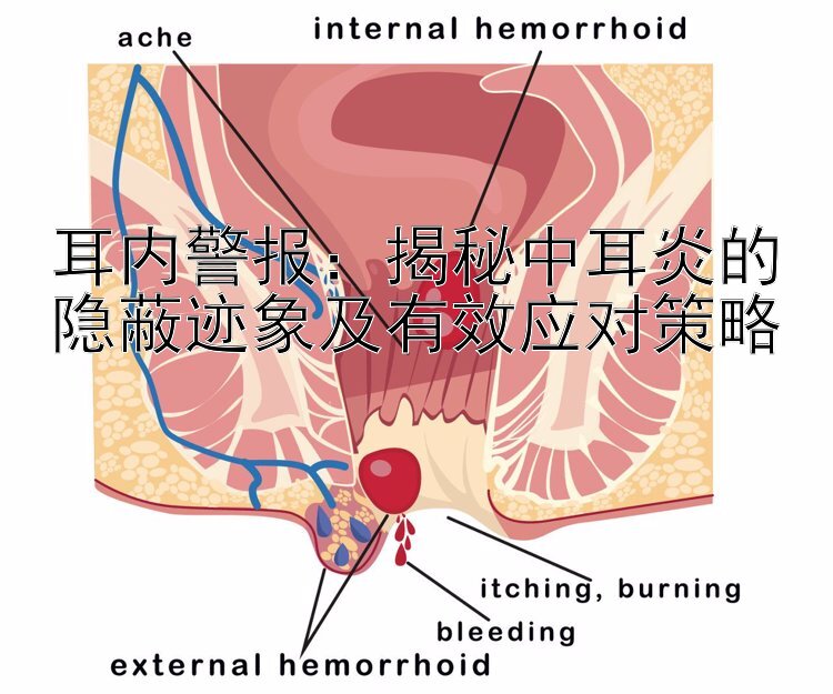 耳内警报：揭秘中耳炎的隐蔽迹象及有效应对策略