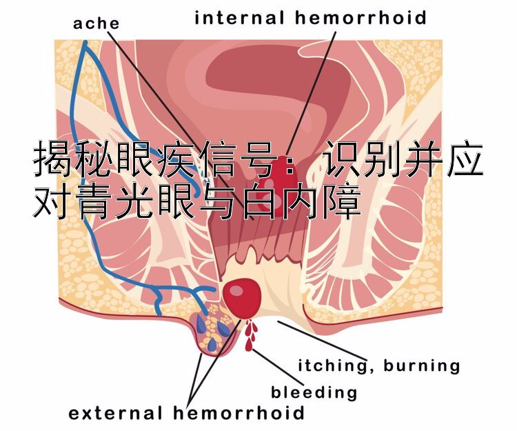 揭秘眼疾信号：识别并应对青光眼与白内障