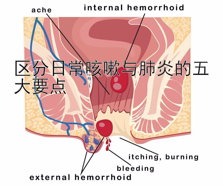 区分日常咳嗽与肺炎的五大要点