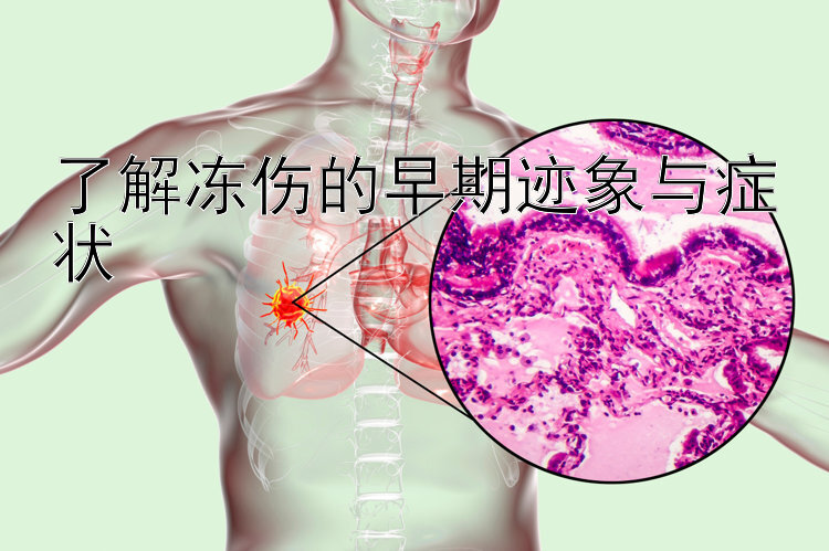 了解冻伤的早期迹象与症状