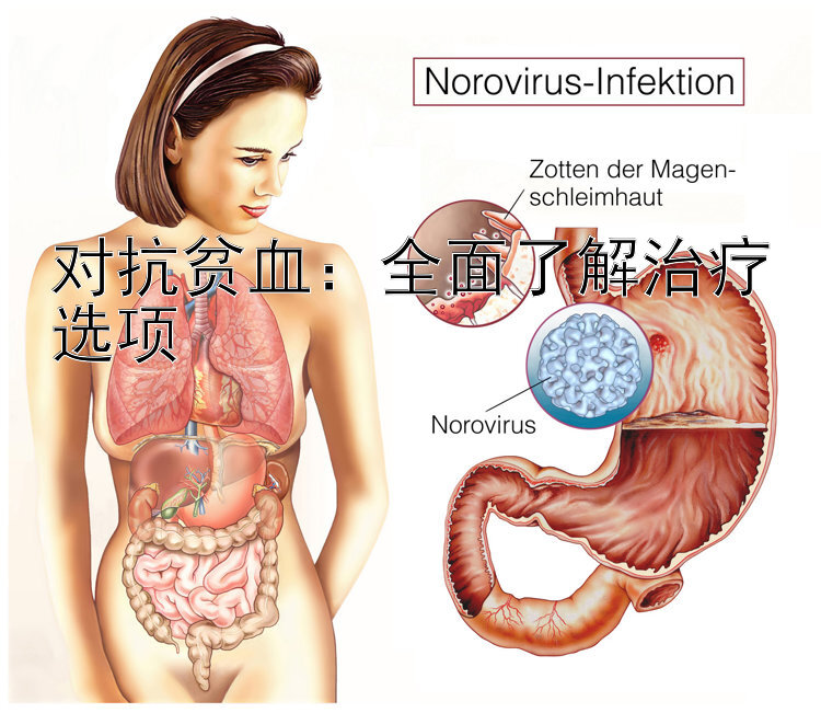 对抗贫血：全面了解治疗选项