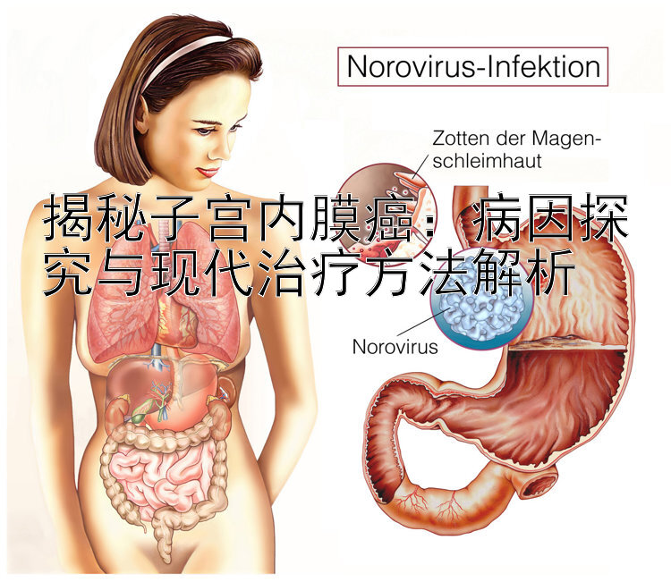 揭秘子宫内膜癌：病因探究与现代治疗方法解析