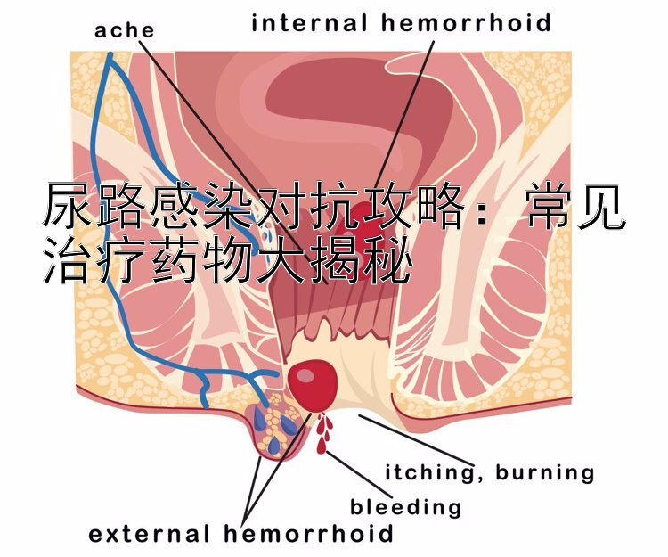 尿路感染对抗攻略：常见治疗药物大揭秘