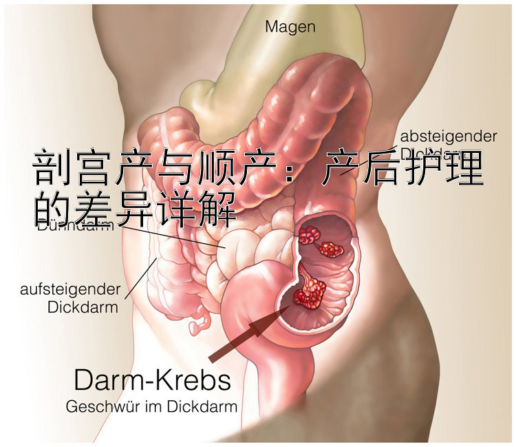 剖宫产与顺产：产后护理的差异详解