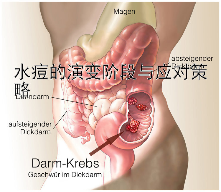 水痘的演变阶段与应对策略